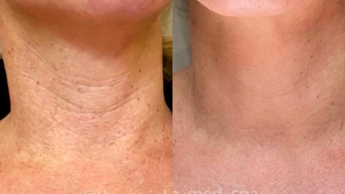 Radiofrequency-before-and-after-neck-area An image of a female neck showing before and after RF skin treatments