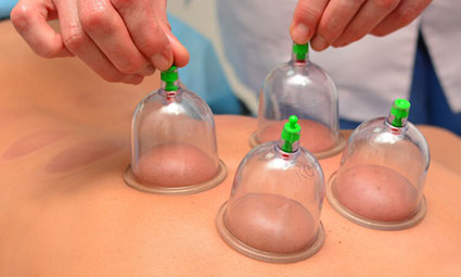 cupping therapy