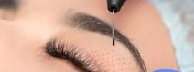 fibroblast plasma lift