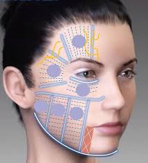 HIFU Non-Surgical Face Lift