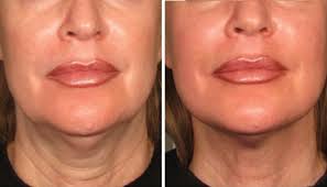 HIFU neck