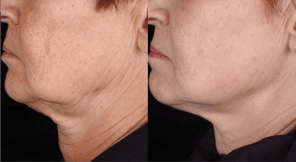 Radio-Frequency-before-and-after-jowl A side view of a female's before and after radio frequency chin area