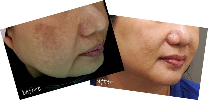 Laser skin lifting treatment