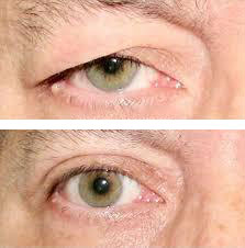 The Plasma Lift