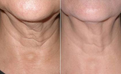 Skin tightening