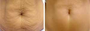 RF for cellulite and fat reduction