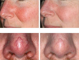 Laser treatment for Rosacea
